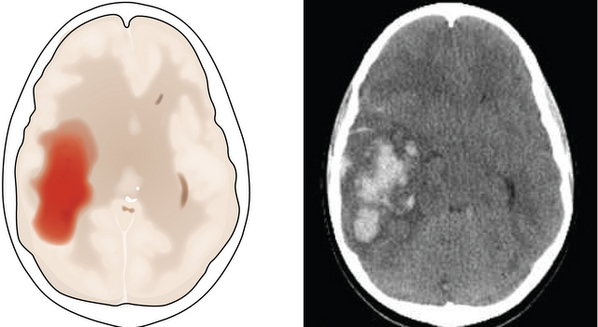 Qual exame de sangue mostra AVC?